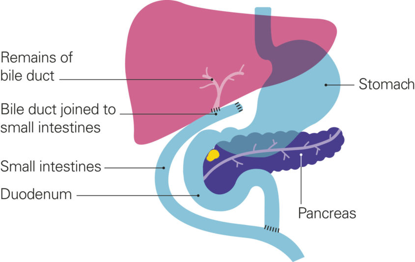 A diagram showing the pancreas after bypass surgery for a blocked bile duct