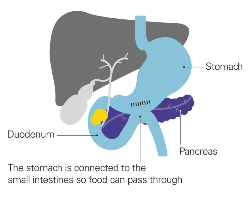 A diagram of the pancreas after bypass surgery for a blocked duodenum