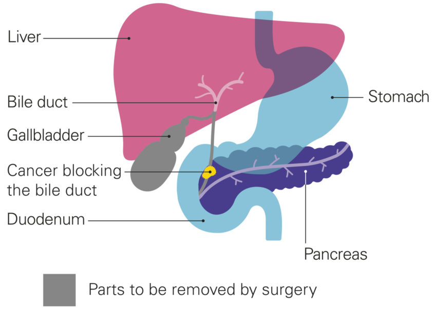 A diagram showing the pancreas with a blocked bile duct