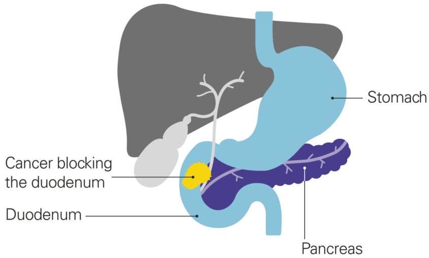 A diagram showing a blocked duodenum