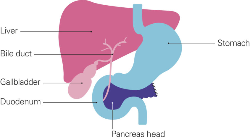 A diagram shows the parts of the body after a distal pancreatectomy. The liver, the gall bladder and the bile duct are on the left, coloured in shades of pink. The stomach and duodenum are in the middle, coloured light blue. The pancreas head sits behind and underneath the stomach, with the duodenum curving around to the left of the pancreas head, which is shown in dark purple and is shown sewn up at the end where the tail used to be. The pancreas tail and the spleen have been removed.