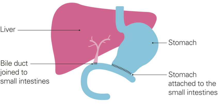 A diagram shows the parts of the body after a distal pancreatectomy. The liver and bile duct are on the left, coloured in shades of pink. The bile duct now connects directly to the small intestines, shown in light blue. The upper half of the stomach also now connects directly to the small intestines. Stitches re shown at the joins. Other organs have been removed.