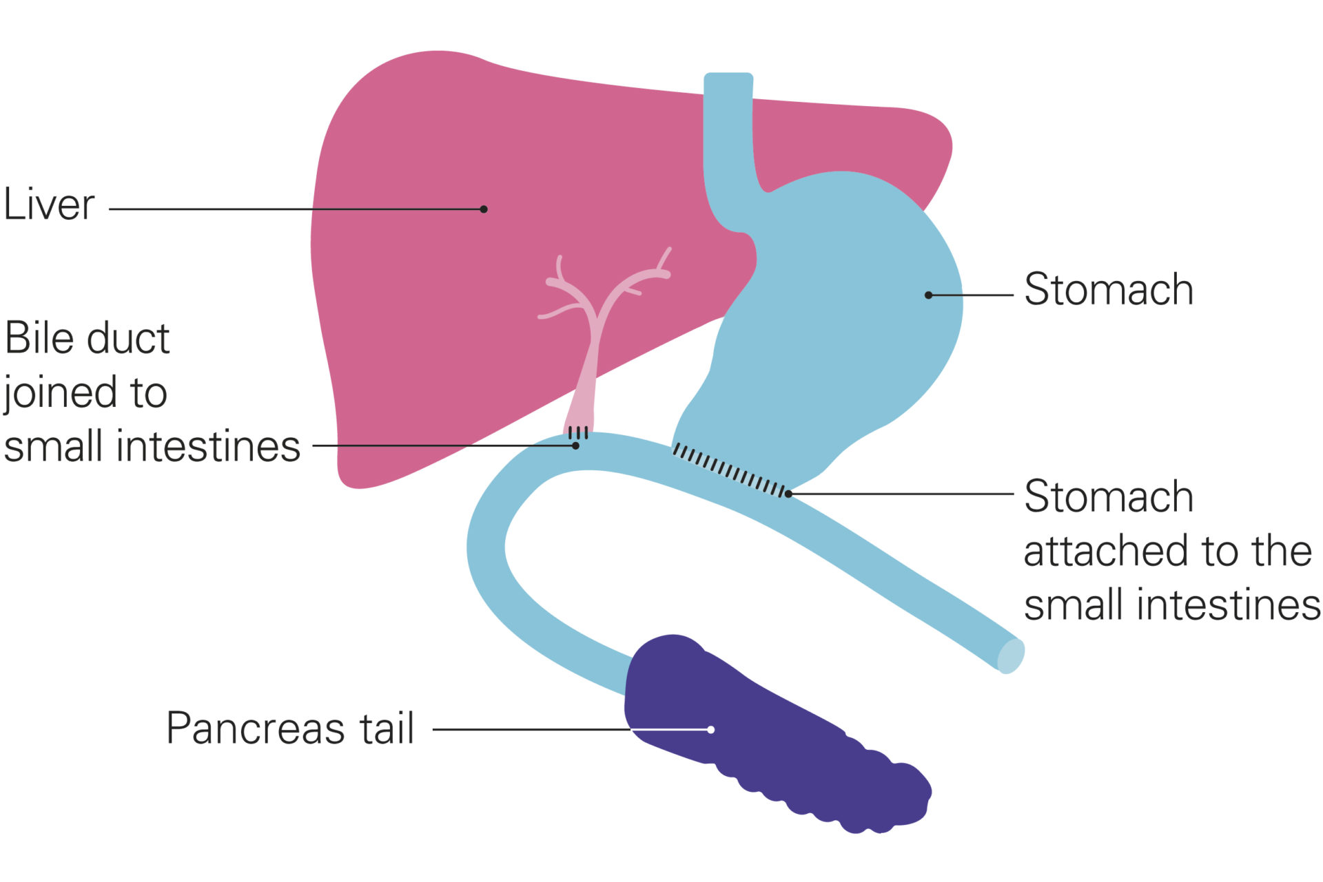 A diagram shows the parts of the body after a Whipple’s. The liver and bile duct are on the left, coloured in shades of pink. The bile duct now connects directly to the small intestines, shown in light blue, which in turn connect to the pancreas tail (dark purple). The stomach also now connects directly to the small intestines. Stitches re shown at the joins. Other organs have been removed. 