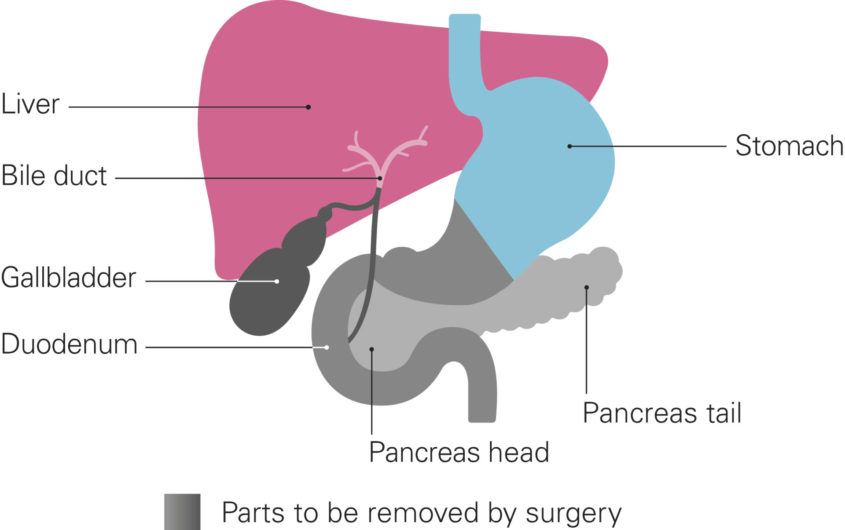 A diagram shows the parts of the body to be removed by a distal pancreatectomy. Grey indicates the parts to be removed. The liver and the bile duct are on the left, coloured in shades of pink. They connect to the gall bladder, shown in grey. The stomach and duodenum are in the middle. The upper part of the stomach is coloured light blue, the lower half and the duodenum are shown in grey. The pancreas sits behind and underneath the stomach, with the duodenum curving around to the left of the pancreas head. The whole of the pancreas is shown in grey.