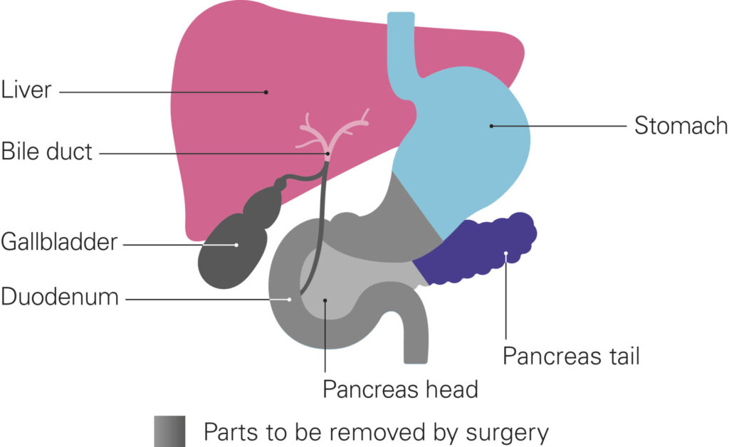 A diagram shows the parts of the body to be removed by a Whipple’s. Grey indicates the parts to be removed. The liver and bile duct are on the left, coloured in shades of pink. The bile duct connects to both the gall bladder and the duodenum. The stomach and duodenum are in the middle. The gall bladder, duodenum and lower half of the stomach are in grey. The upper part of the stomach is coloured light blue. The pancreas sits behind and underneath the stomach, with the duodenum curving around to the left of the pancreas head, which is shown in grey. The pancreas tail is dark purple. 