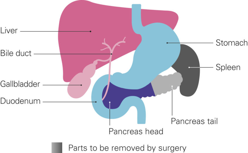 A diagram shows the parts of the body to be removed by a distal pancreatectomy. Grey indicates the parts to be removed. The liver and gall bladder are on the left, coloured in shades of pink. The stomach and duodenum are in the middle, coloured light blue. The pancreas sits behind and underneath the stomach, with the duodenum curving around to the left of the pancreas head, which is shown in dark purple. The pancreas tail, and the spleen, which is to the right, are shown in grey.