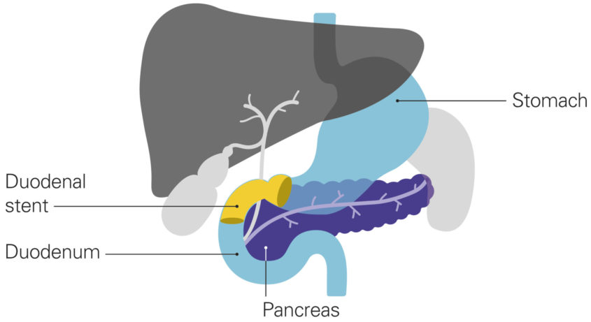 A diagram of a stent for a blocked duodenum