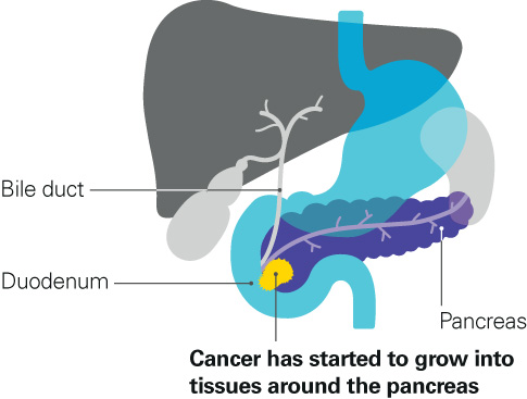 Diagram showing stage 2 pancreatic cancer