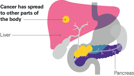Diagram showing stage 4 pancreatic cancer