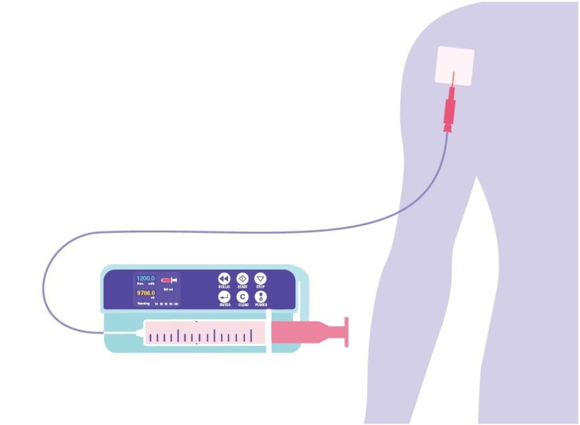 The pump is made up of a rectangular box with 6 buttons including power, start and stop. Below the buttons is a small syringe, like those used for blood tests. The syringe is connected to the upper arm by a long thin tube which ends in a needle, held in place with a patch on the skin.