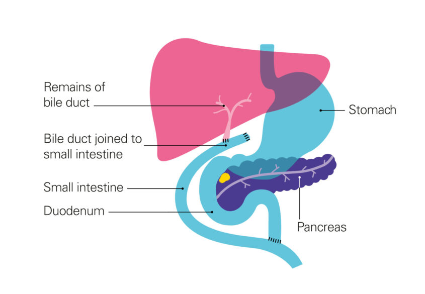 Diagram showing bile duct after bypass surgery