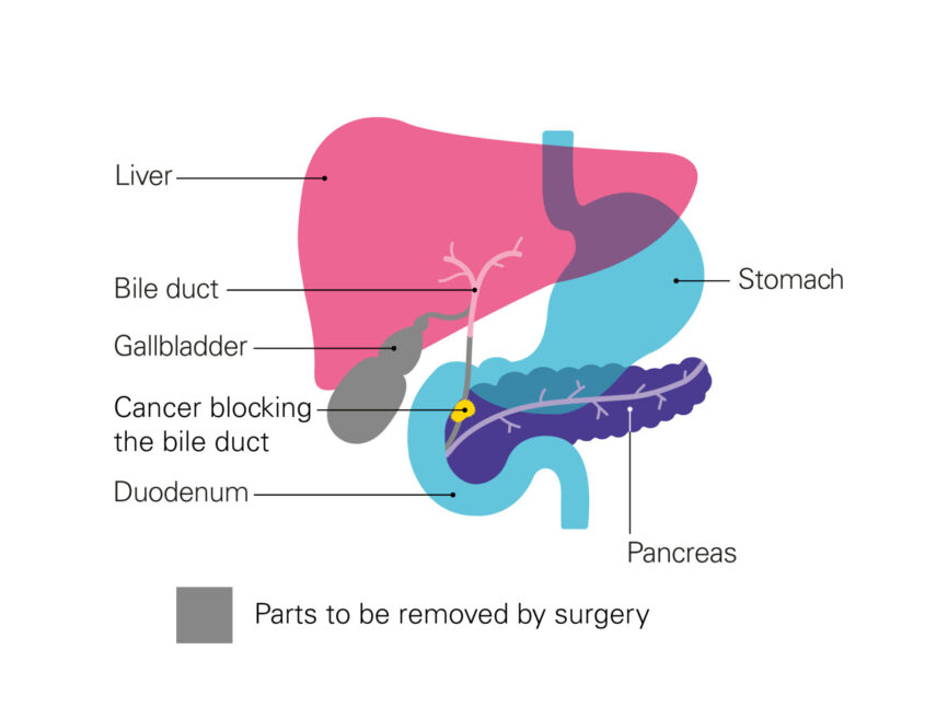 Diagram showing bile duct and blockage caused by cancer before bypass surgery