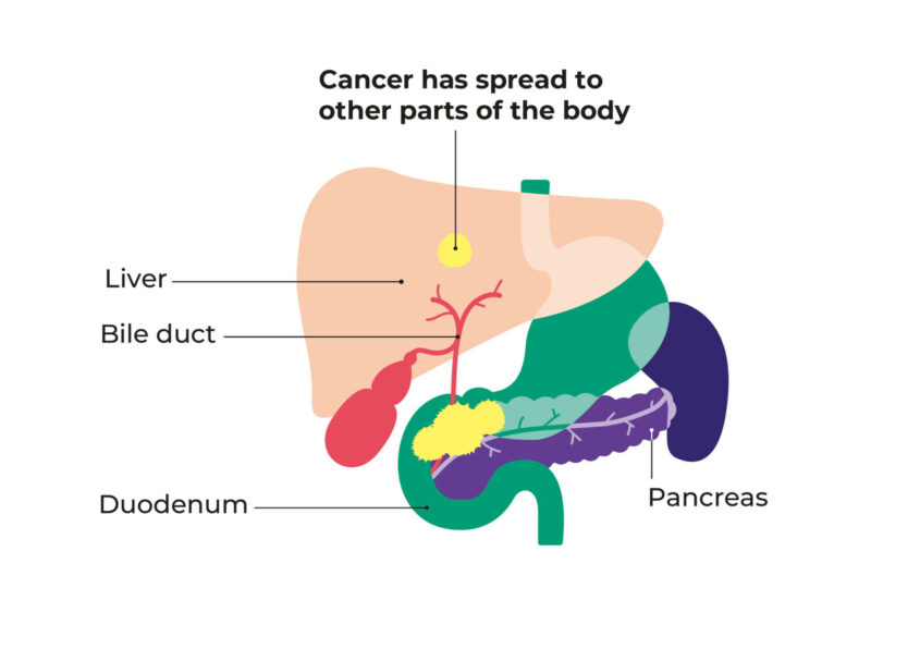 Diagram showing stage 4 pancreatic cancer. the cancer is shown in the pancreas and spread to other organs