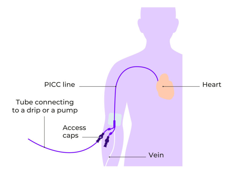 Basic diagram showing where the PICC line is inserted and where it sits in the body