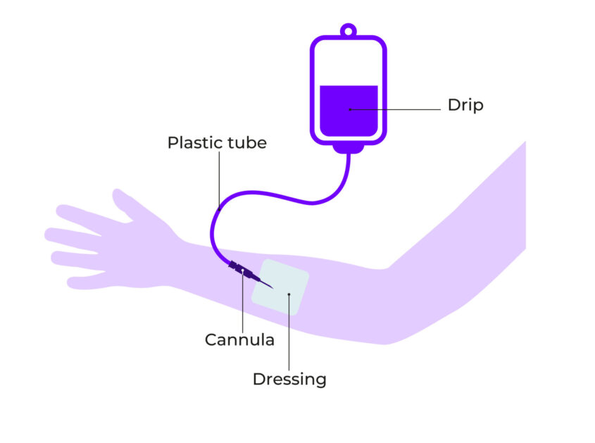 Basic diagram showing a cannula in the arm attached to a drip
