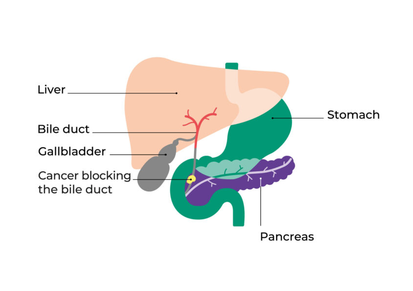 Diagram showing the cancer blocking the bile duct