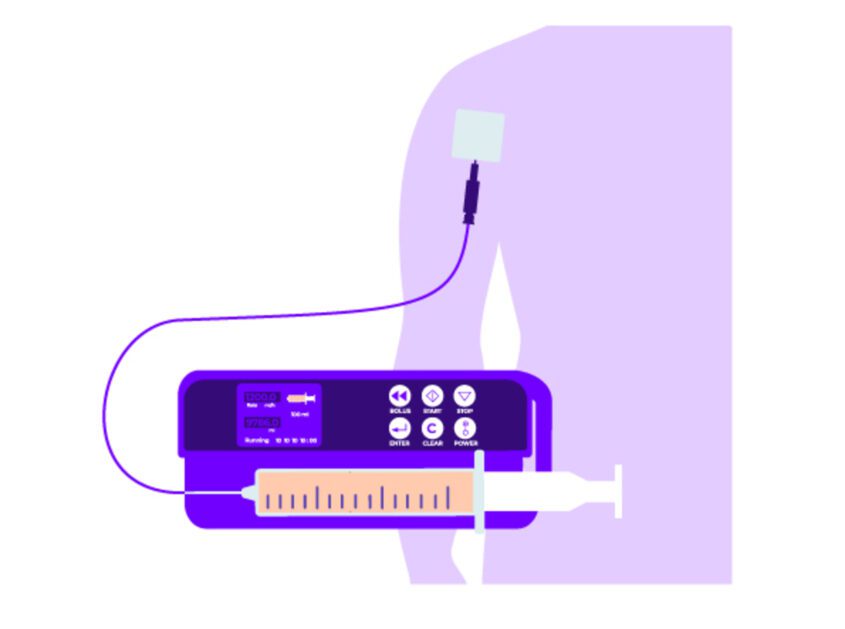 Diagram showing syringe pump and how it attaches to the body